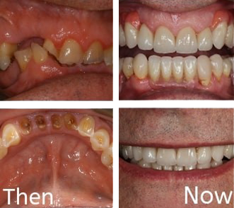 Straightening And Bonding at Start Smiling Dentist in Essex